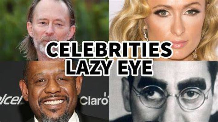 Actors With The Allure Of A Lazy Eye