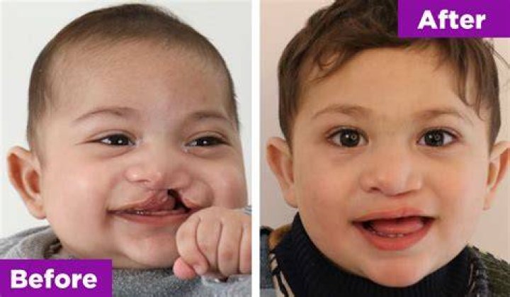 Cleft Palate Before And After The Spotlight