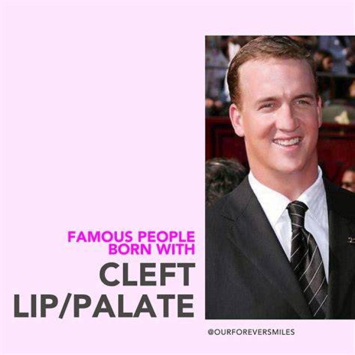 Famous Faces And The Inspiring Stories Of Cleft Palate