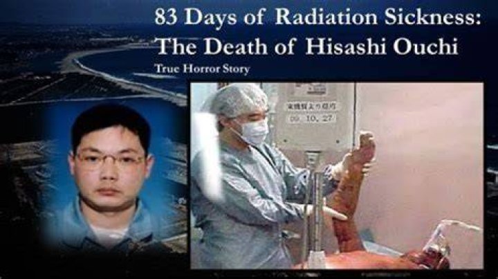 Hisashi Ouchi: The Tragic Story Of The World's Longest Survivor Of A Nuclear Accident.