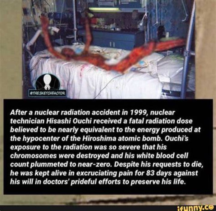The Horrific Case Of Hisashi Ouchi: Radiation-Induced Skin Shedding