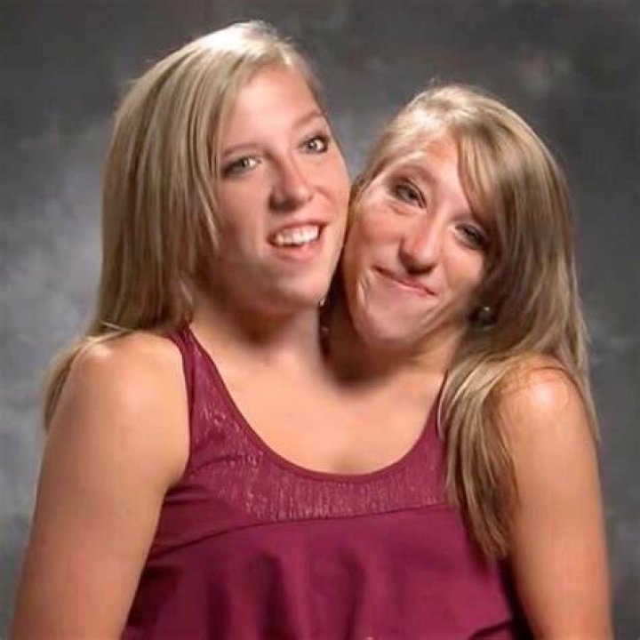 Untimely Demise Of Conjoined Twins Abby And Brittany Hensel