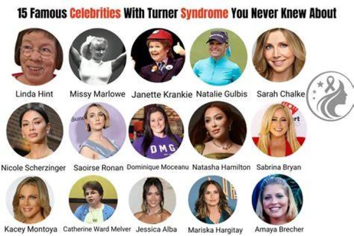 Unveiling The Remarkable Journeys Of Famous People With Turner Syndrome